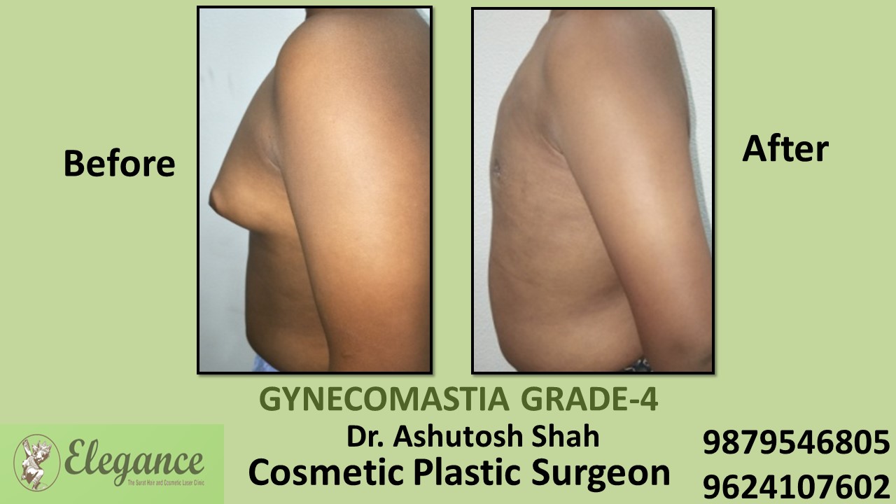 Gynecomastia Grade-4 Treatment, Kim, Gujarat, India.