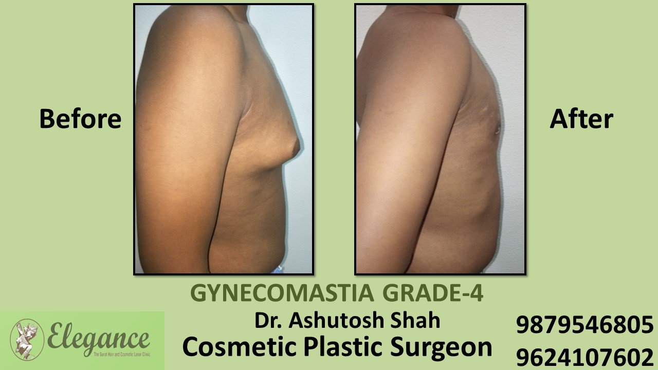 Gynecomastia Grade-4 Treatment, Kosamba, Gujarat, India.