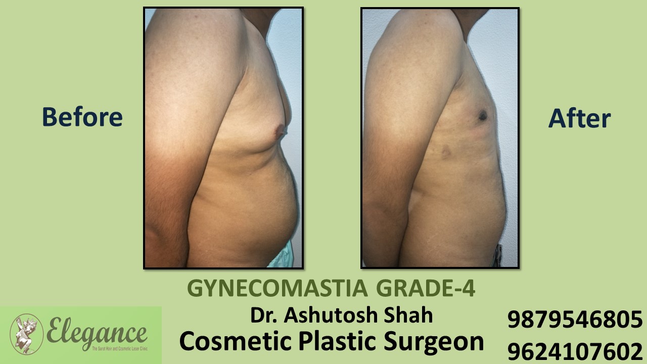 Gynecomastia Grade-4 Treatment, Mangrol, Gujarat, India.