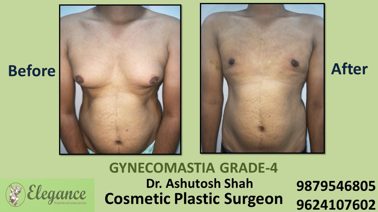 Gynecomastia Grade-4 Treatment, NAVSARI, Gujarat, India.
