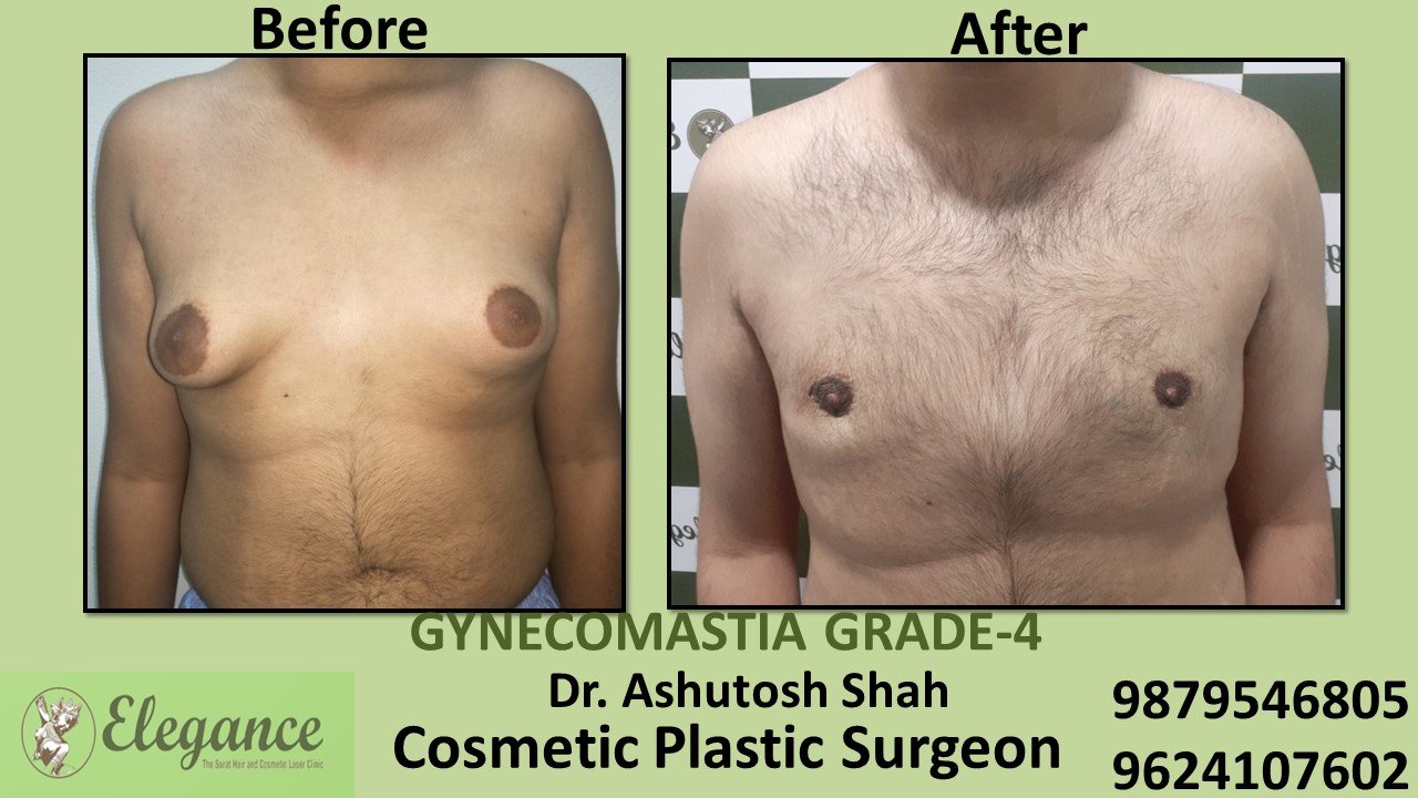 Gynecomastia Grade-4 Treatment, Selvasa, Gujarat, India.