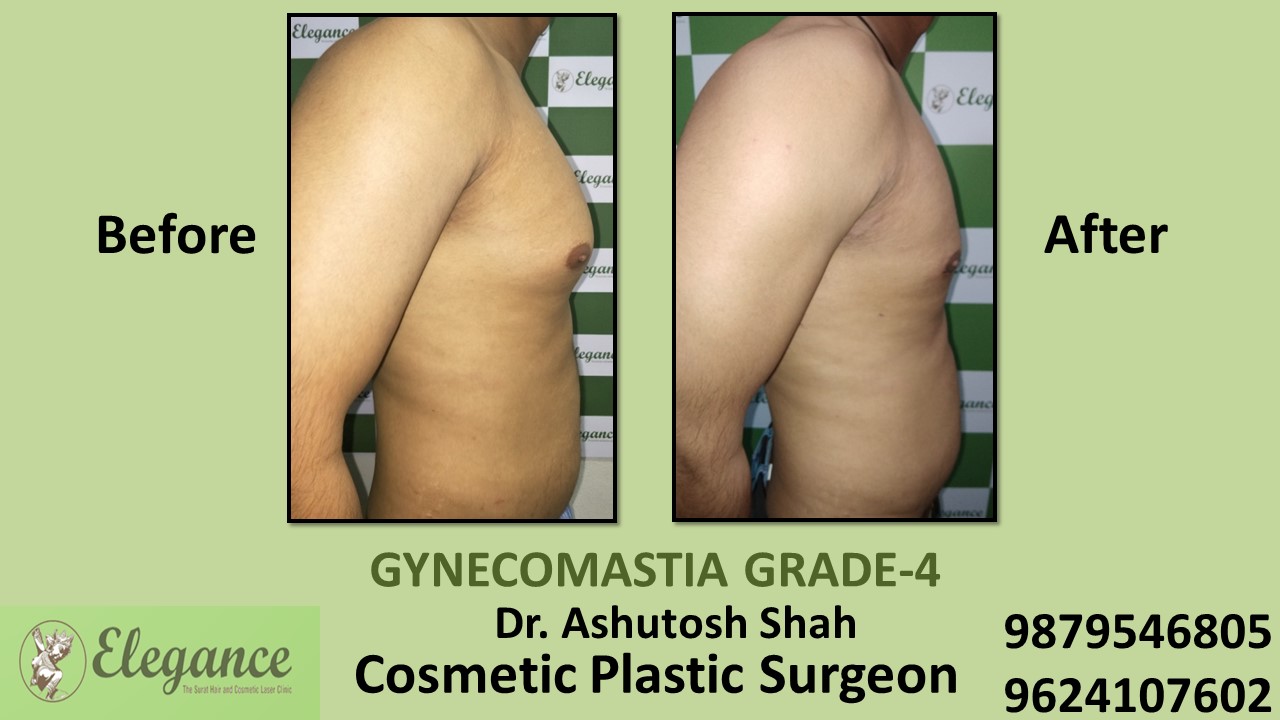 Gynecomastia Grade-4 Treatment, Surat, Gujarat, India.