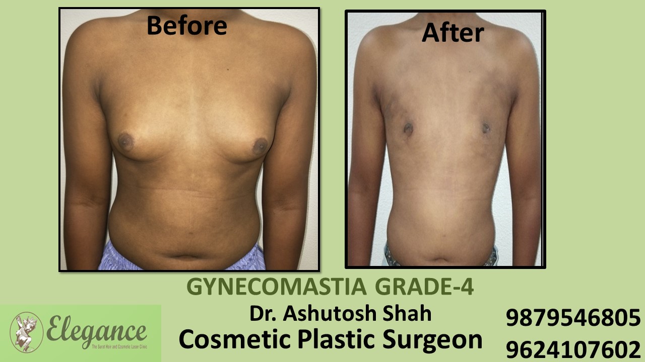 Gynecomastia Grade-4 Treatment, Vadodara, Gujarat, India.