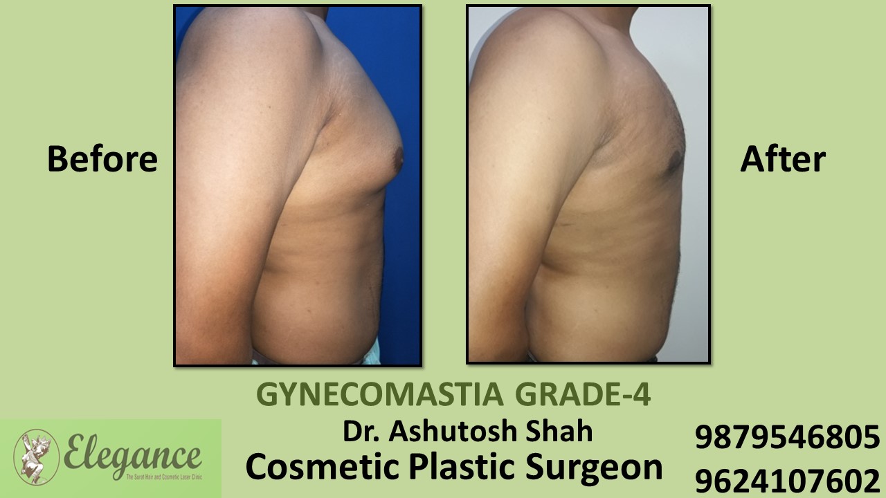 Gynecomastia Grade-4 Treatment, Valsad, Gujarat, India.