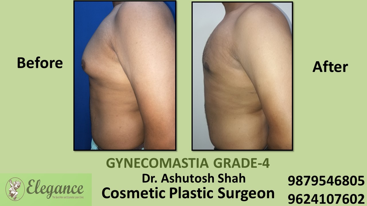 Gynecomastia Grade-4 Treatment, Vapi, Gujarat, India.