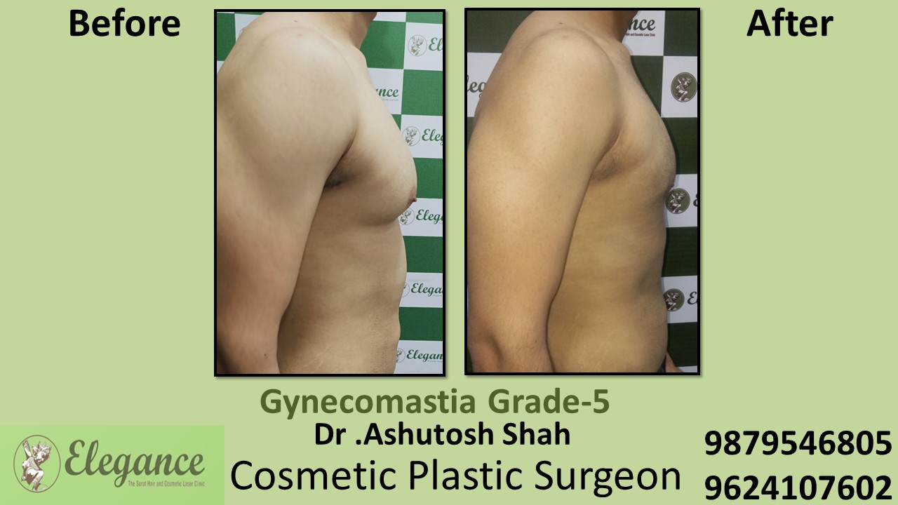 Gynecomastia Grade-5 Significant Breast Roll SURGERY, Surat, Gujarat, India.