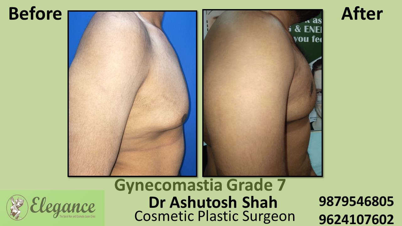 Gynecomastia Grade 7, Bharuch, Gujarat, India