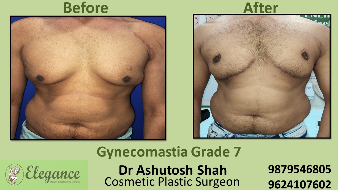 Grade 7 Gynecomastia Huge Female like Breasts Treatment in Surat