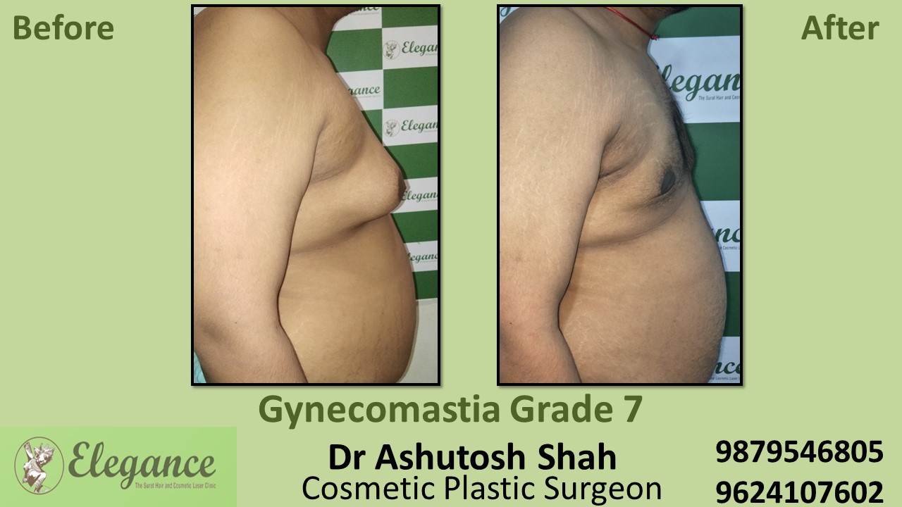 Gynecomastia Grade 7 Surgery, Ankleshwar, Gujarat, India