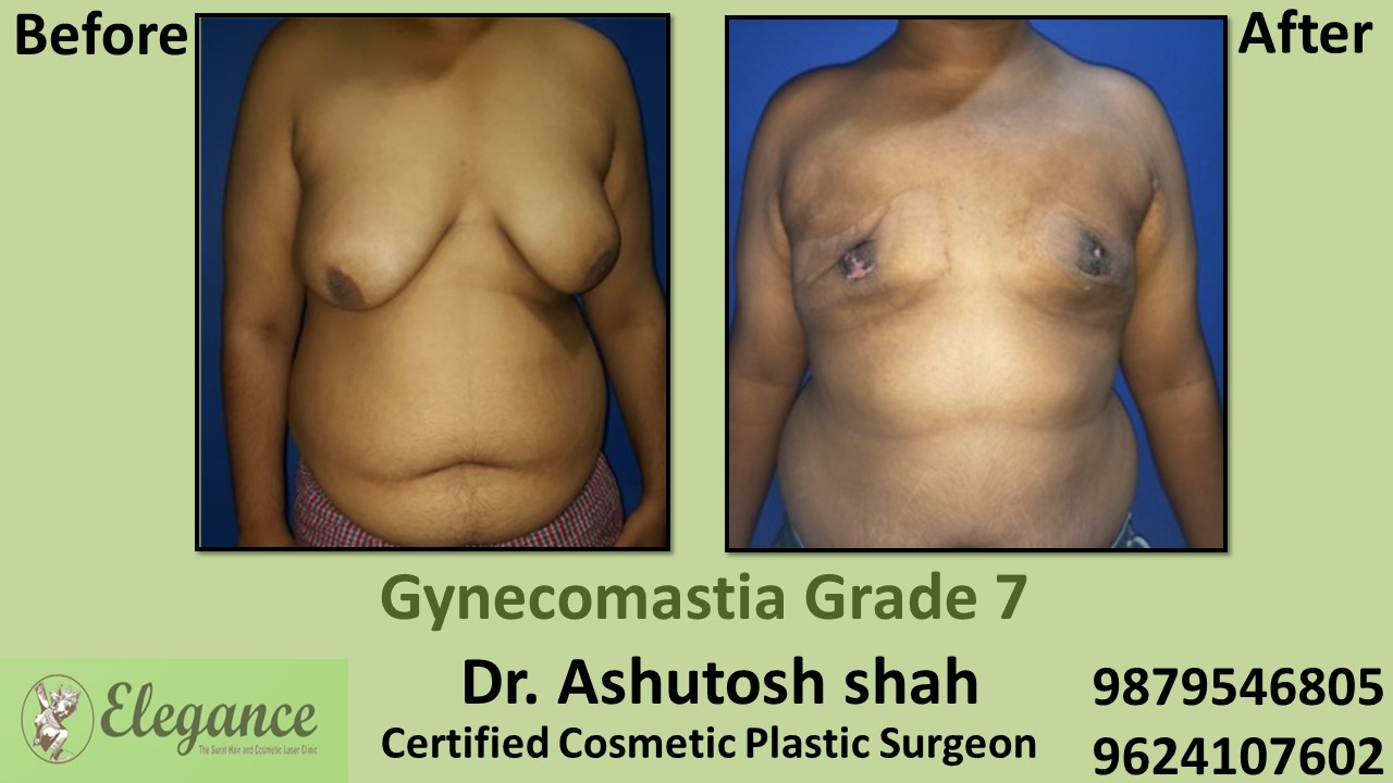 Gynecomastia Grade 7 Surgery, Bharuch, Gujarat, India