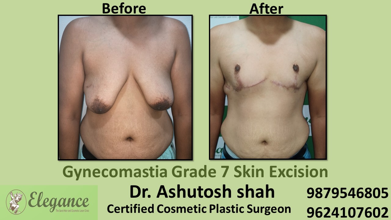 Gynecomastia Grade 7 Surgery, Bilimora, Gujarat, India