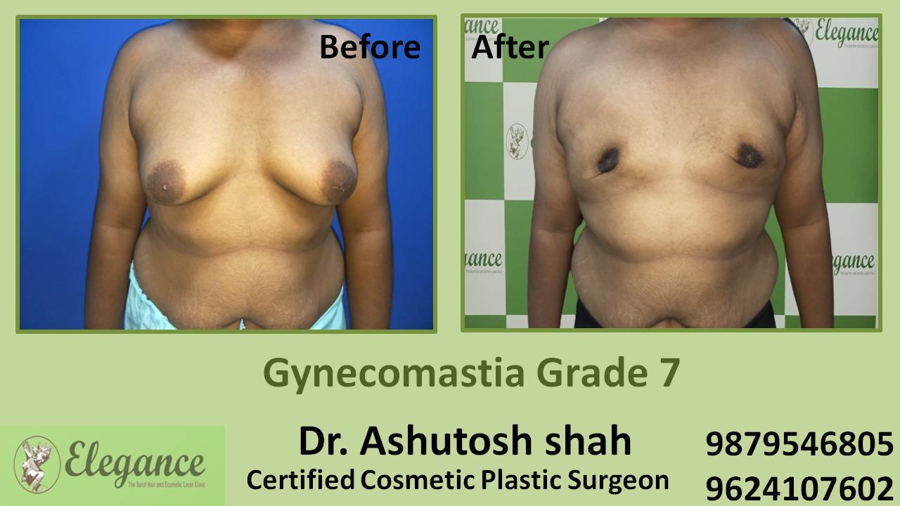 Gynecomastia Grade 7 Surgery, Chhota Udaipur, Gujarat, India