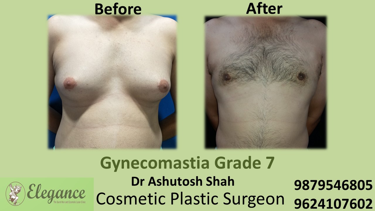 Gynecomastia Grade 7 Surgery, Chikhli, Gujarat, India