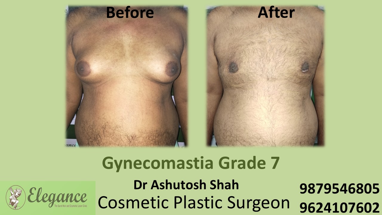 Gynecomastia Grade 7 Surgery, Daman, Gujarat, India