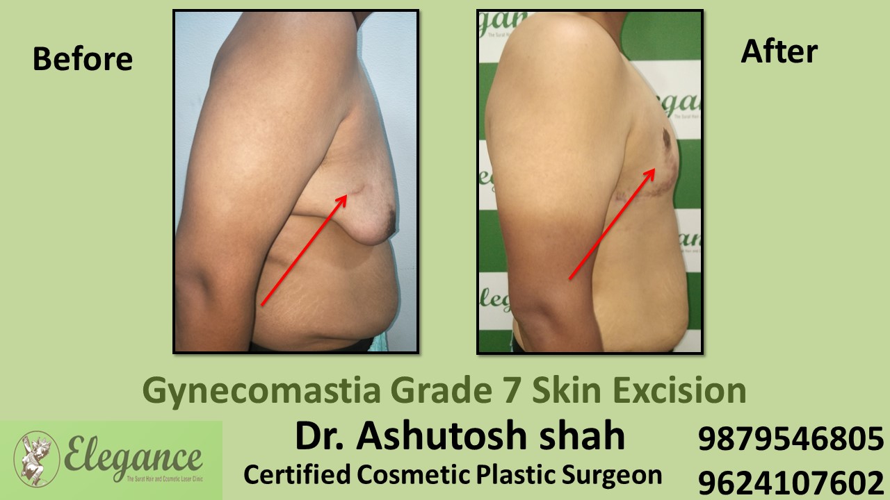Gynecomastia Grade 7 Surgery, Kosamba, Gujarat, India