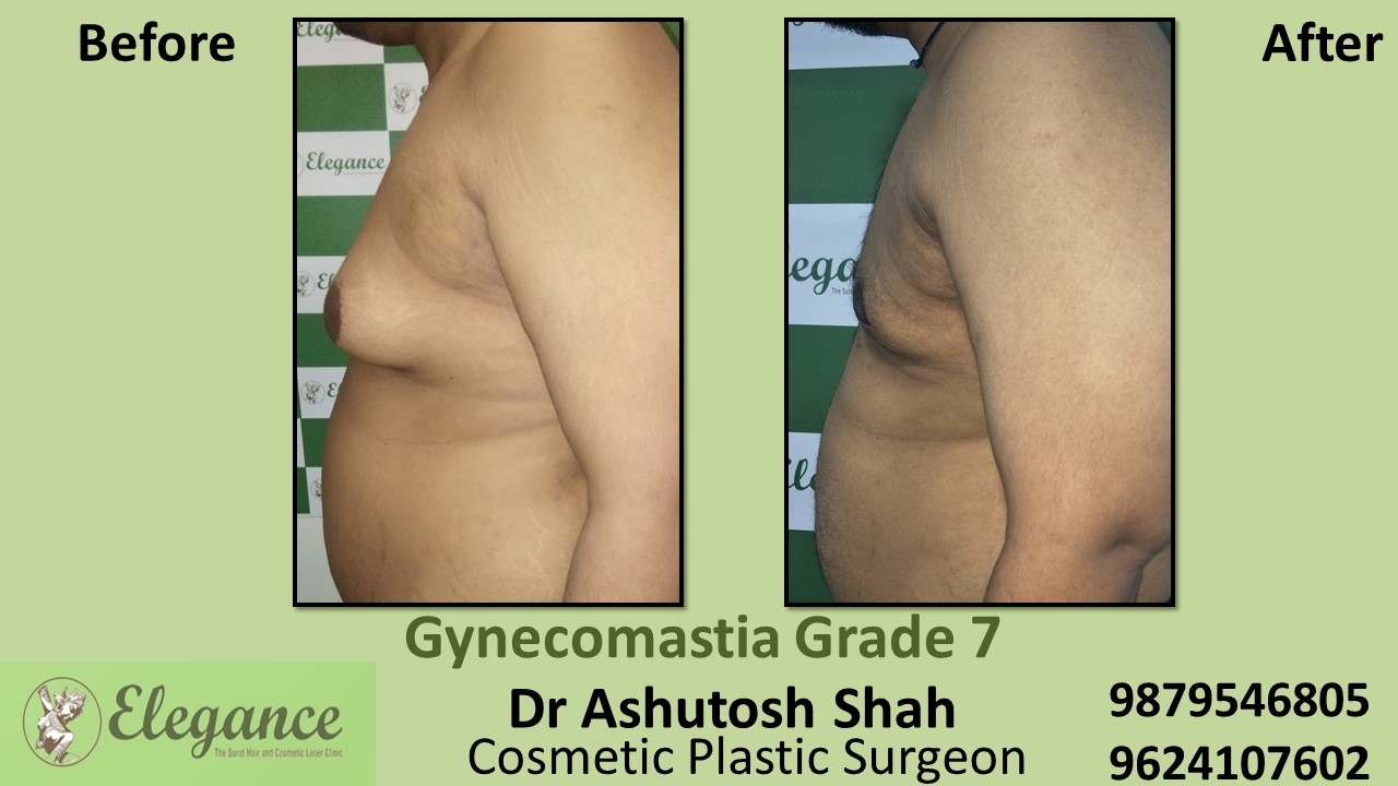 Gynecomastia Grade 7 Surgery, Mangrol, Gujarat, India