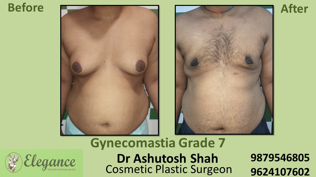 Gynecomastia Grade 7 Surgery, Navsari, Gujarat, India