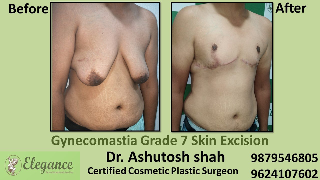 Gynecomastia Grade 7 Surgery, Surat, Gujarat, India