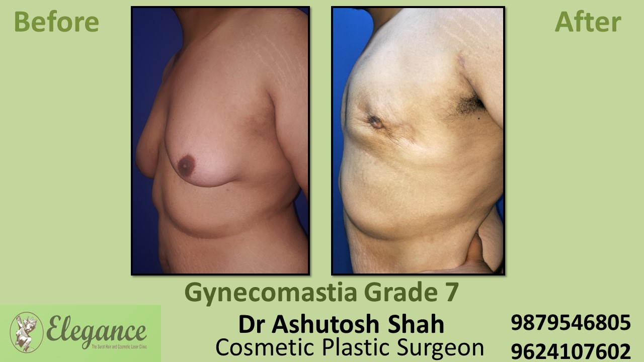 Gynecomastia Grade 7 Surgery, Valsad, Gujarat, India
