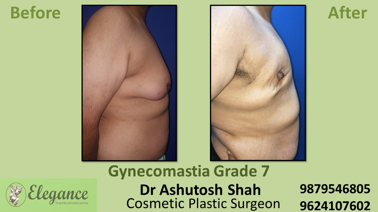Gynecomastia Grade 7 Surgery, Vapi, Gujarat, India