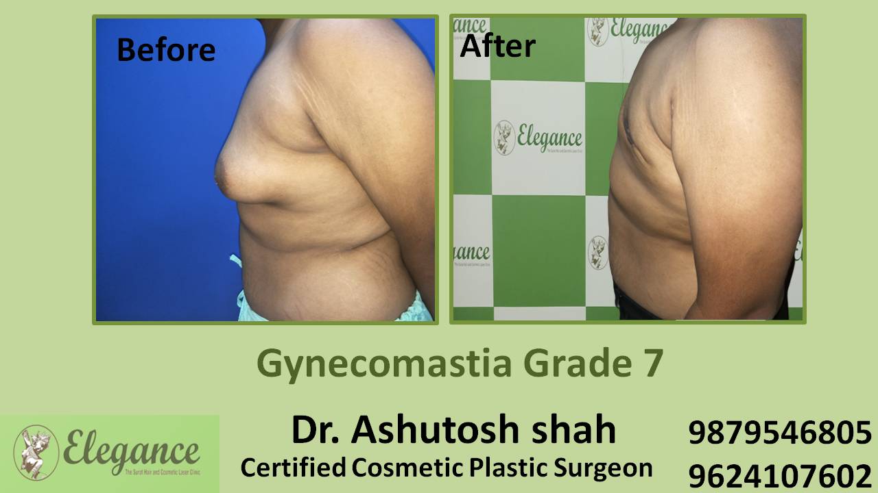 Gynecomastia Grade 7 Treatment, Baroda, Gujarat, India