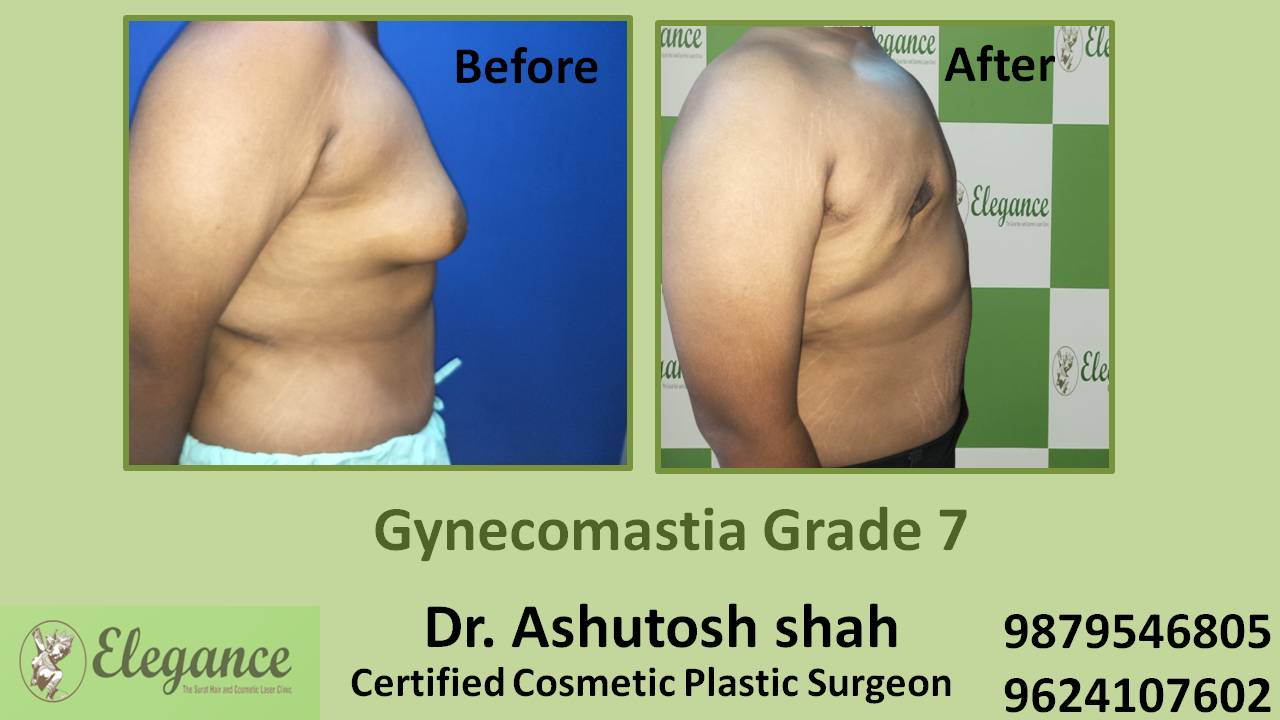 Gynecomastia Grade 7 Treatment, Navsari, Gujarat, India