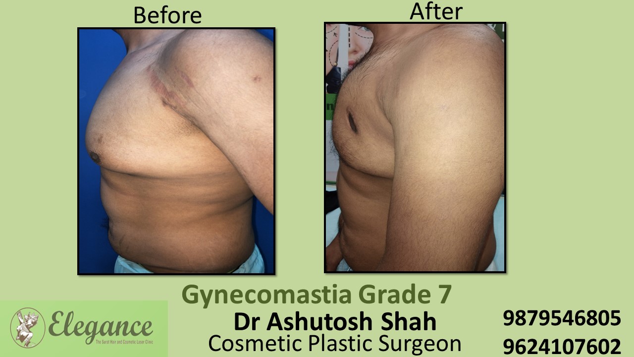 Gynecomastia Grade 7, Vadodara, Gujarat, India