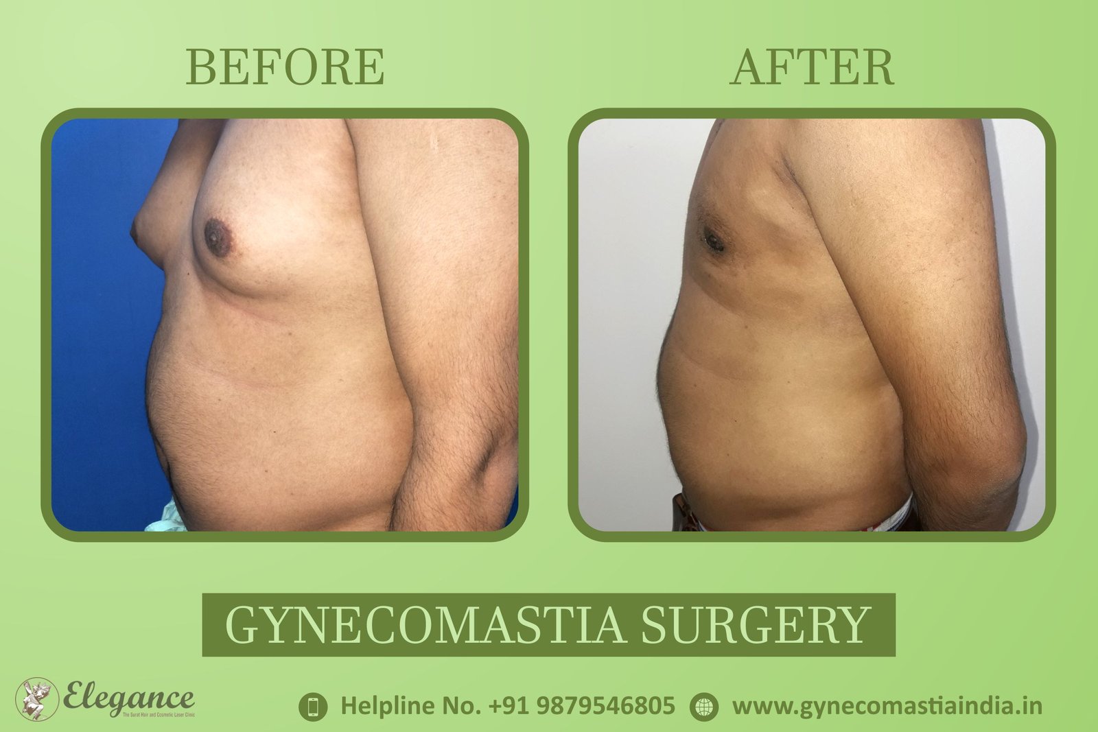 Gynecomastia in Bardoli Price