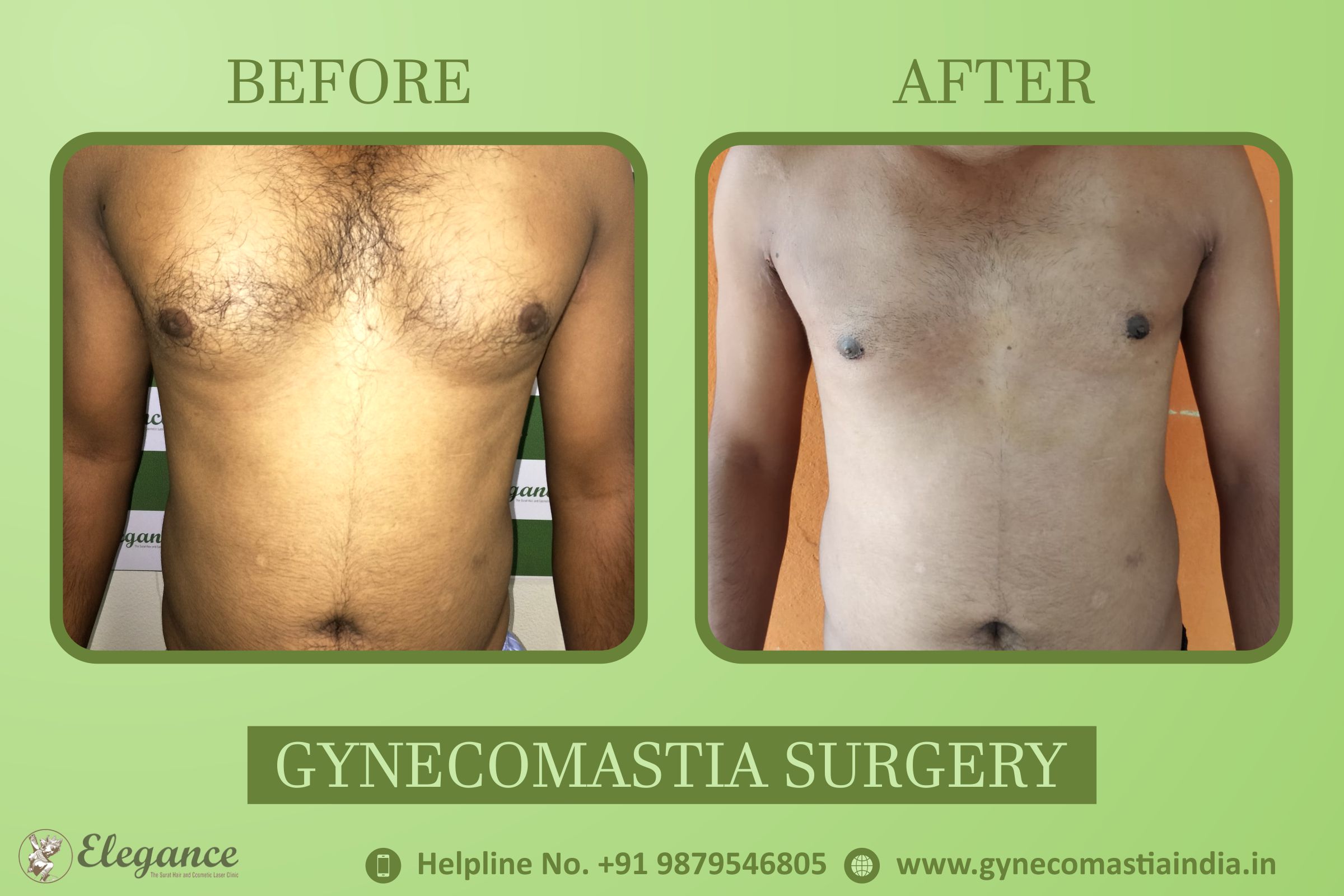 Gynecomastia – Male Breast Surgery in Surat, Gujarat (India)