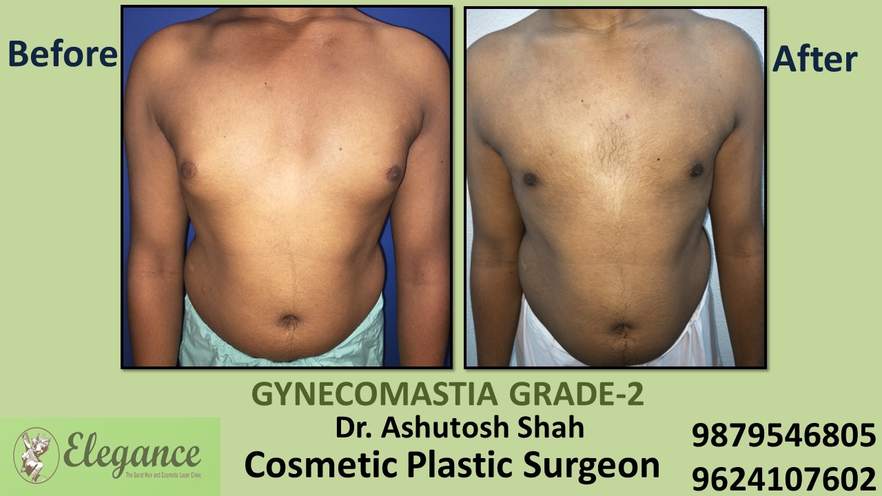 Gynecomastia Rounded Chest Grade -2 Surgery, Bilimora, Gujarat.
