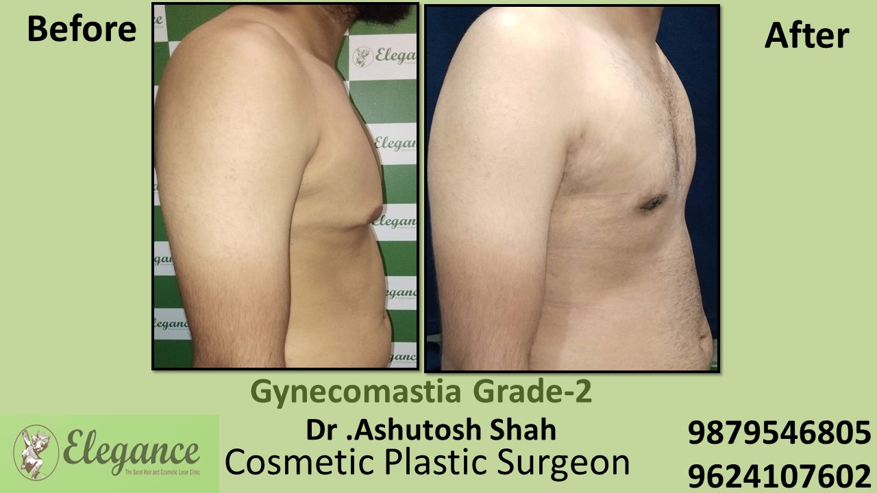 Gynecomastia Rounded Chest Grade -2 Surgery, Chhota Udaipur, Gujarat.