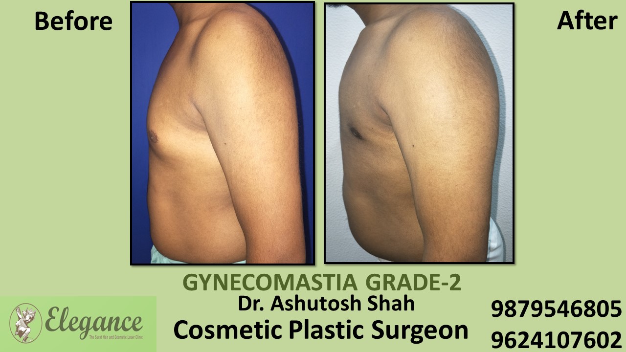 Gynecomastia Rounded Chest Grade -2 Surgery, Chikhli, Gujarat.