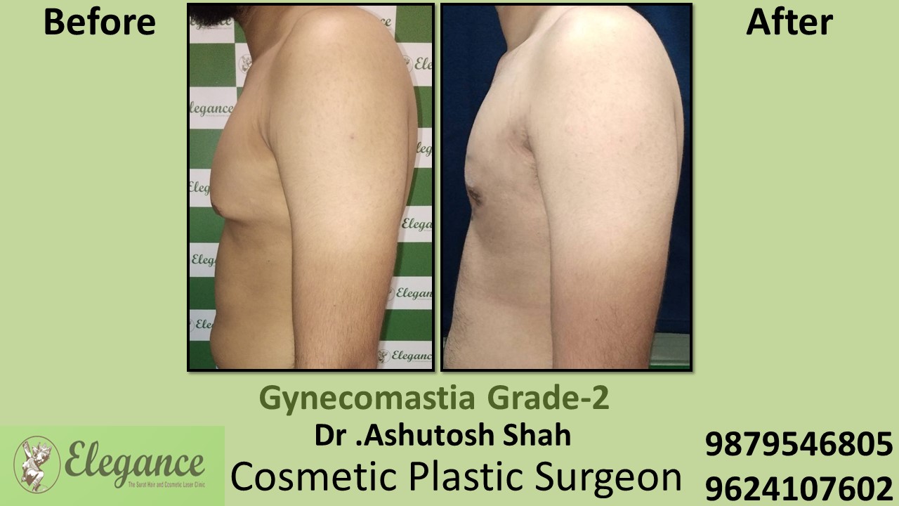 Gynecomastia Rounded Chest Grade -2 Surgery, Daman, Gujarat.