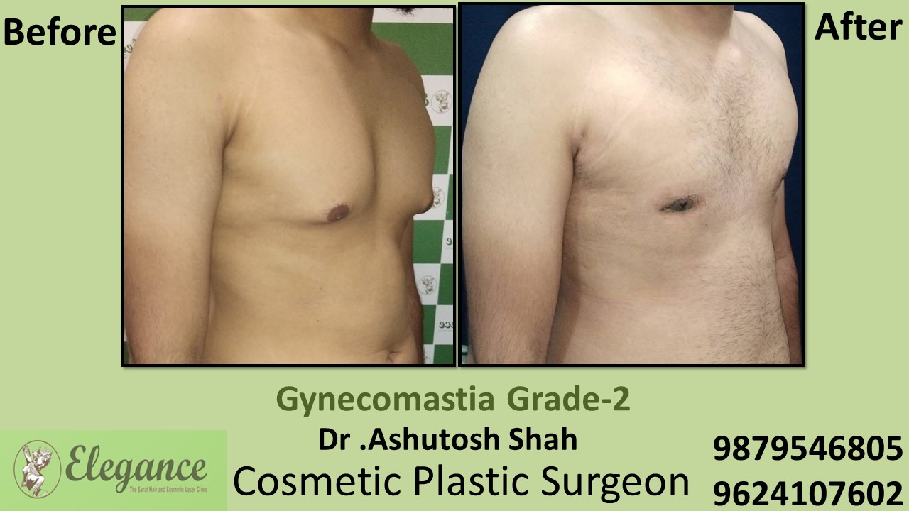 Gynecomastia Rounded Chest Grade -2 Surgery, Kamrej, Gujarat.