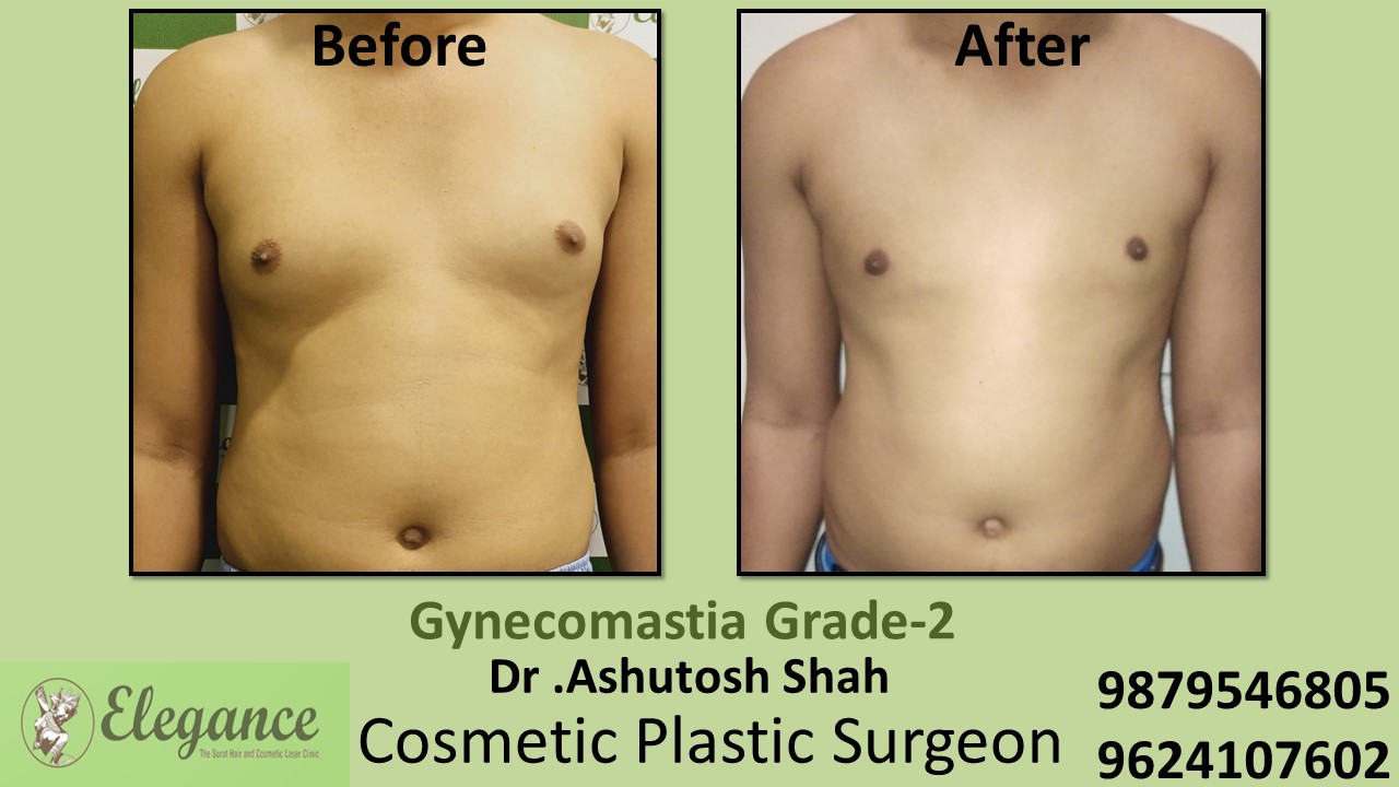 Gynecomastia Rounded Chest Grade -2 Surgery, Kim, Gujarat.
