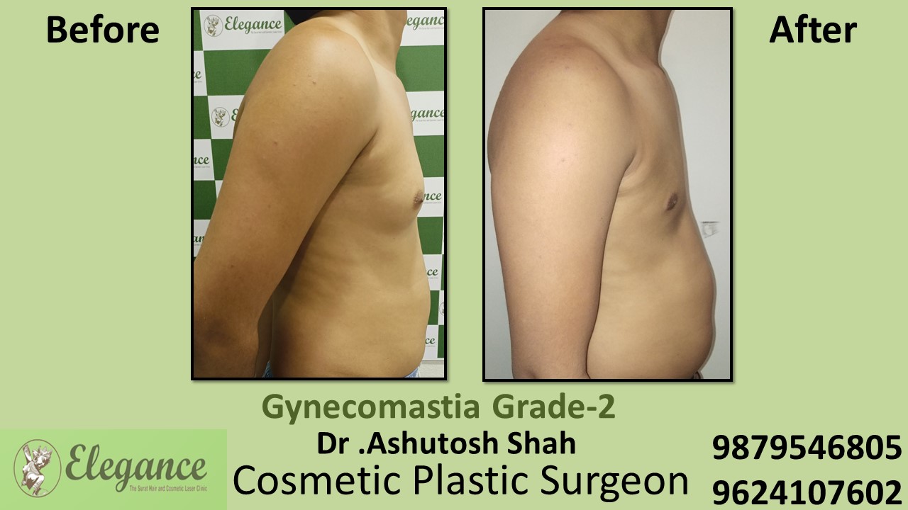 Gynecomastia Rounded Chest Grade -2 Surgery, Kosamba, Gujarat.