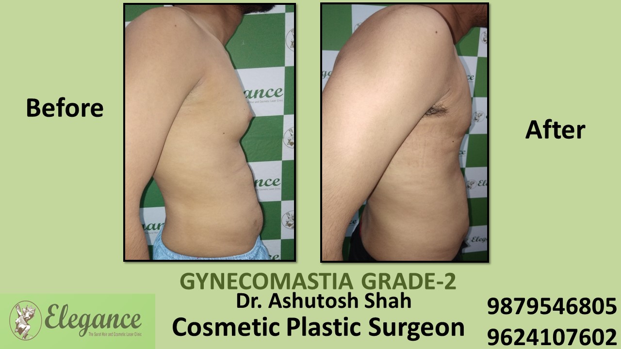 Gynecomastia Rounded Chest Grade -2 Surgery, Mangrol, Gujarat.