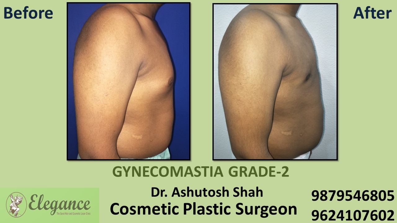 Gynecomastia Rounded Chest Grade -2 Surgery, Navsari, Gujarat.