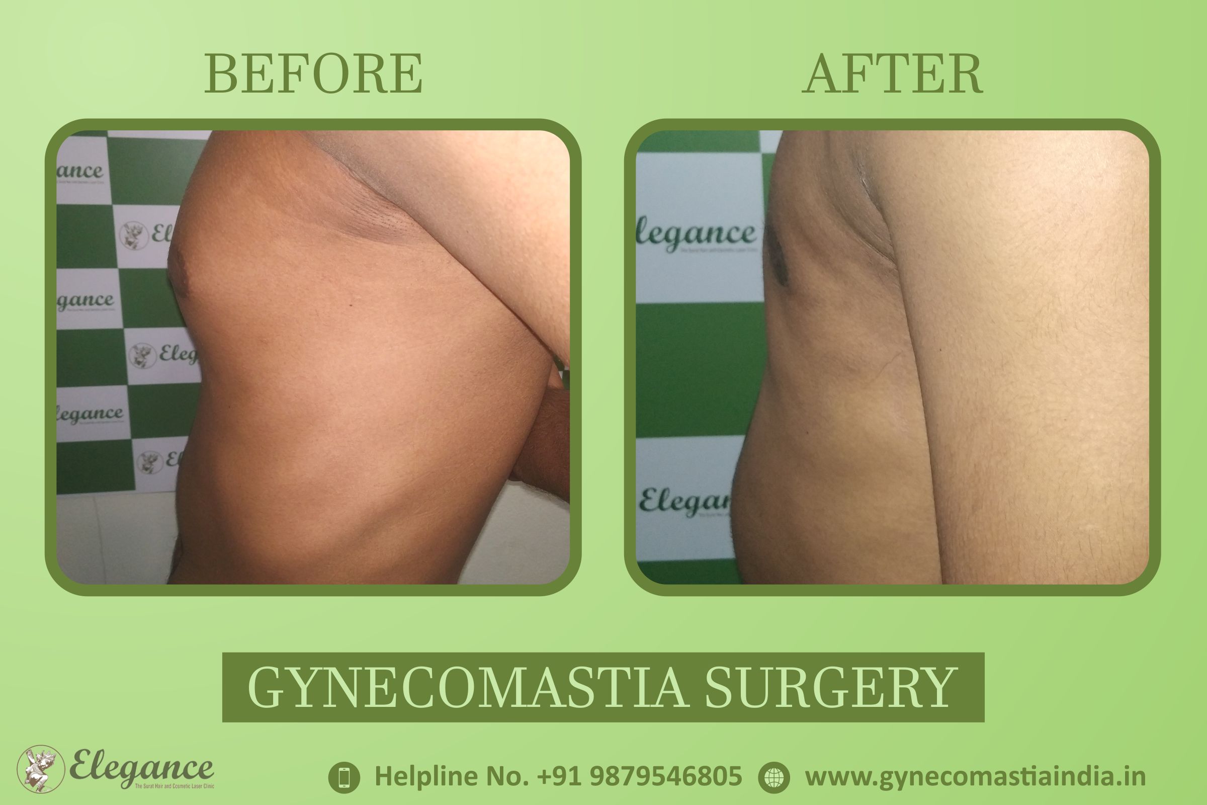 Gynecomastia Clinic in Surat, Gujarat, india