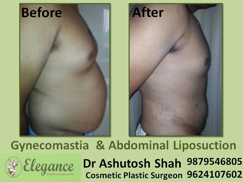 Belly Fat Reduction Surat, Gujarat