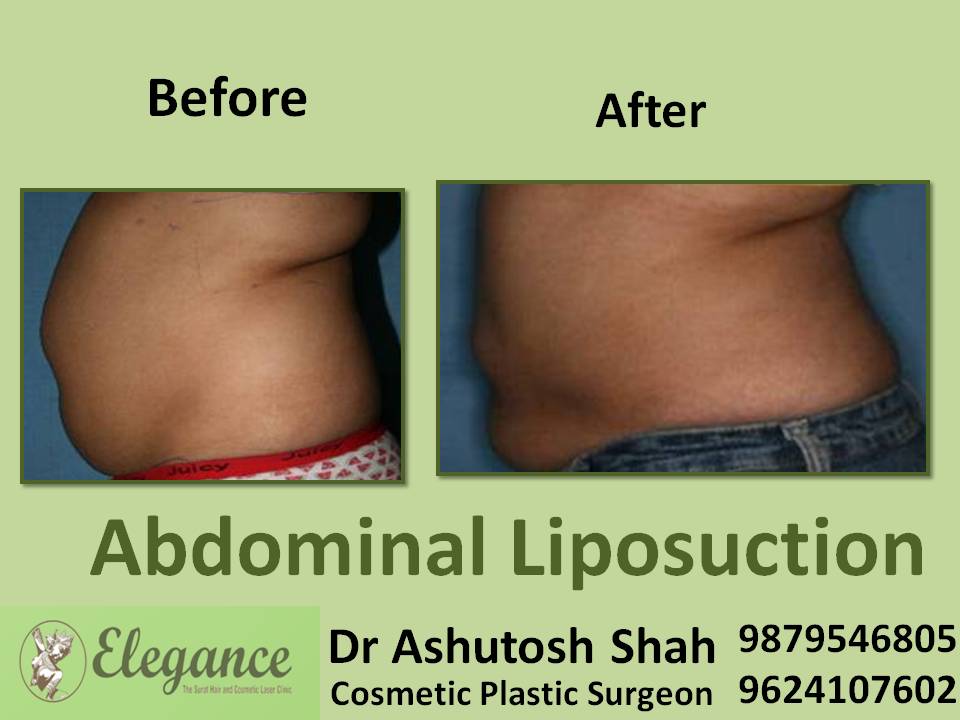 Tummy Fat Reduction Surgery at Low Cost in Surat, Gujarat