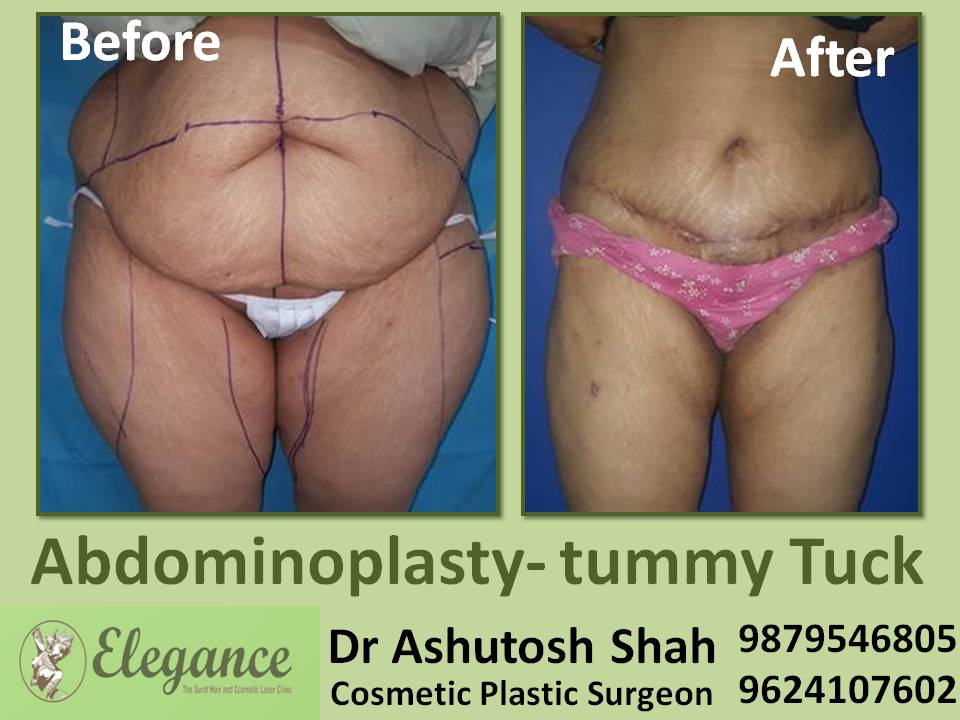 Excess Tummy Fats Reduction near Navsari, Gujarat