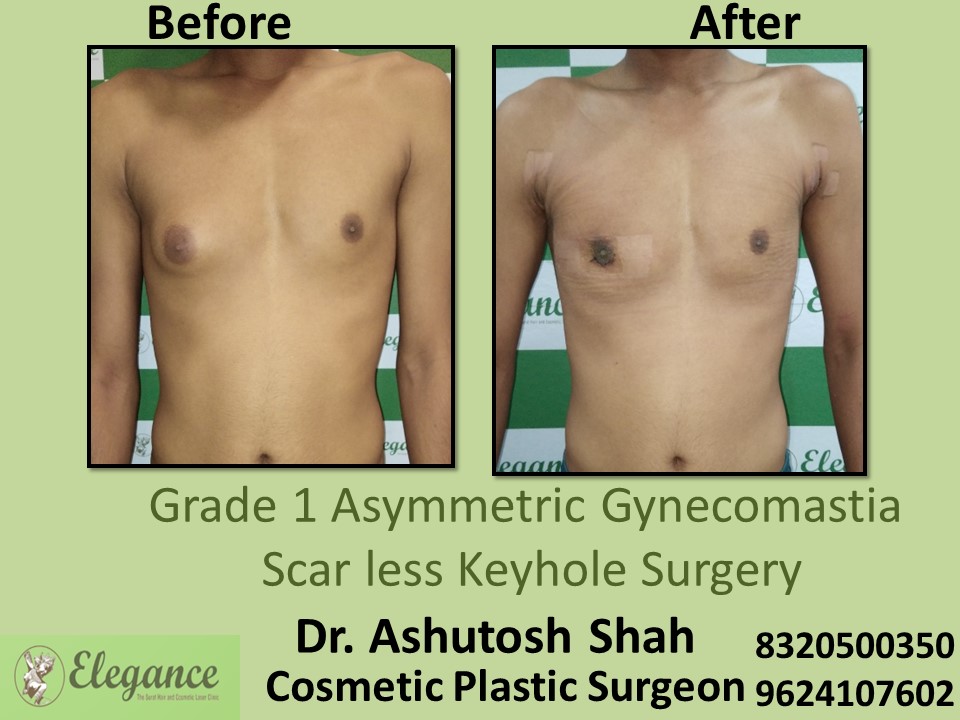 Grade 1 Asymmetric Gynecomastia, Scar Less Keyhole Surgery in Vesu, Surat