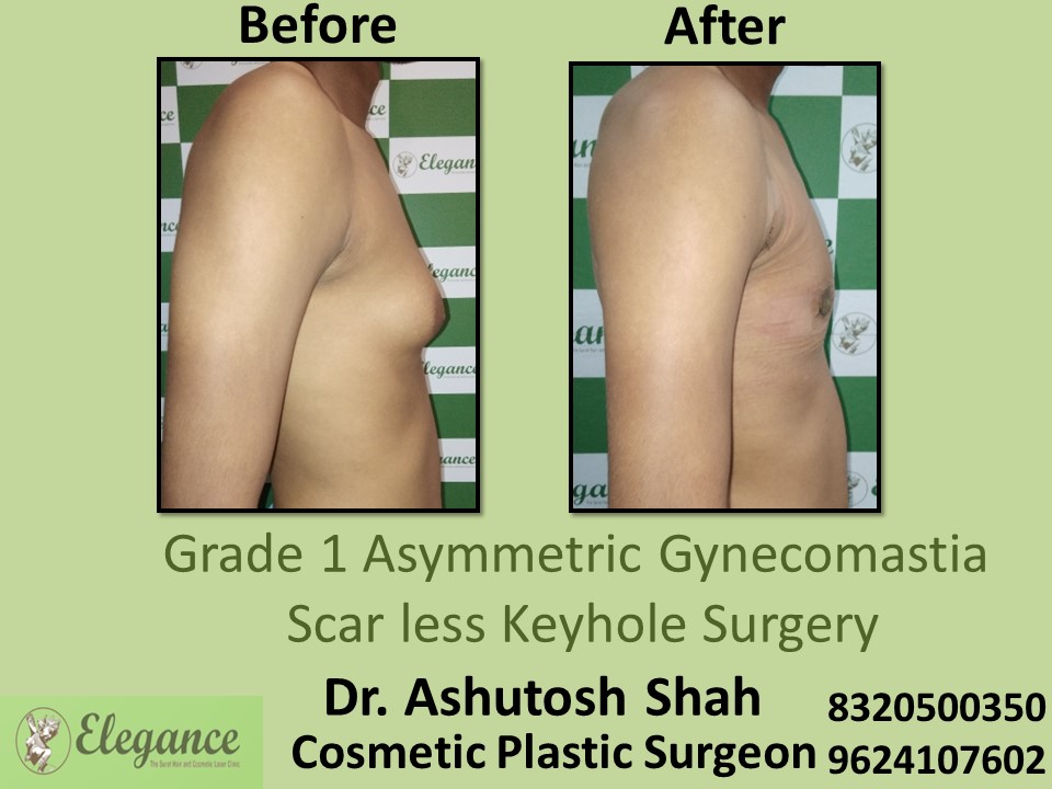 Grade 1 Asymmetric Gynecomastia, Scar Less Keyhole Surgery in Piplod, Surat