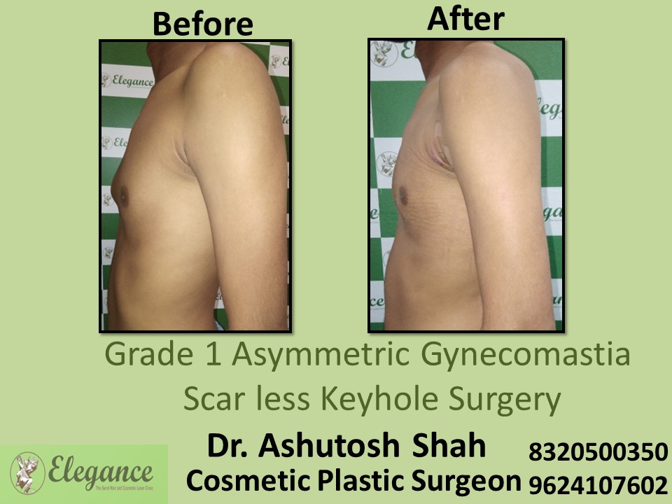 Grade 1 Asymmetric Gynecomastia, Scar Less Keyhole Surgery in Piplod, Udhna Surat