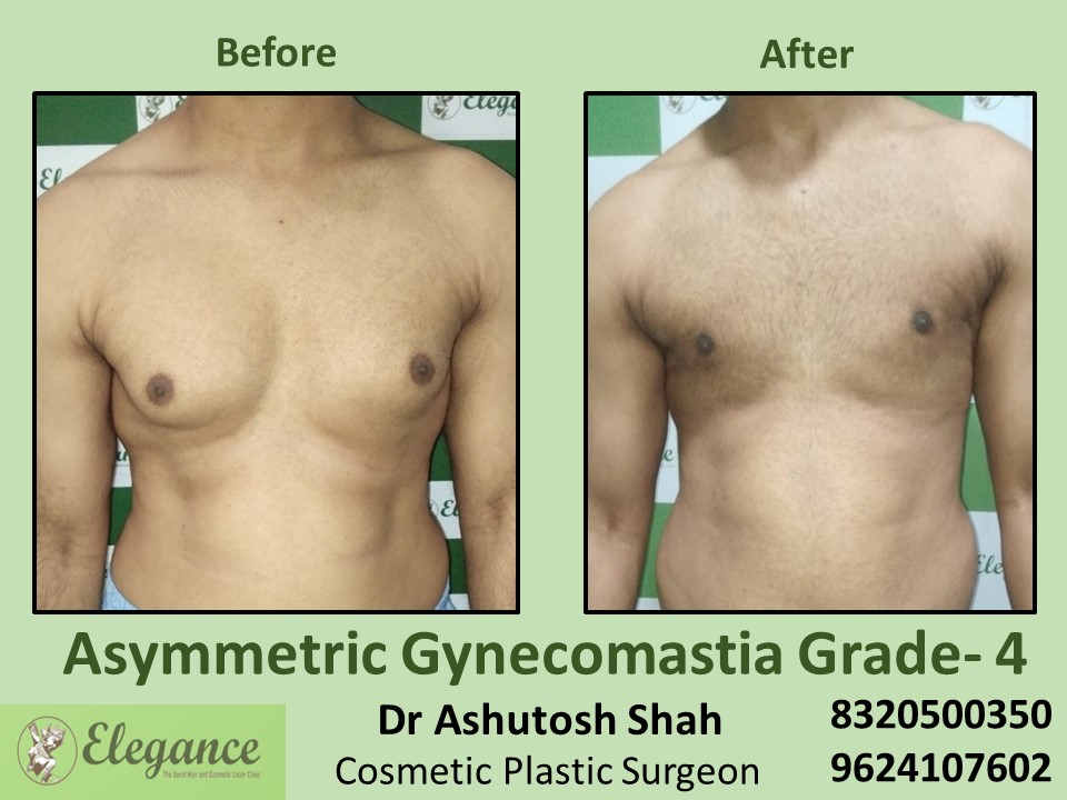 Asymmetric Gynecomastia | Breast Reduction in Surat
