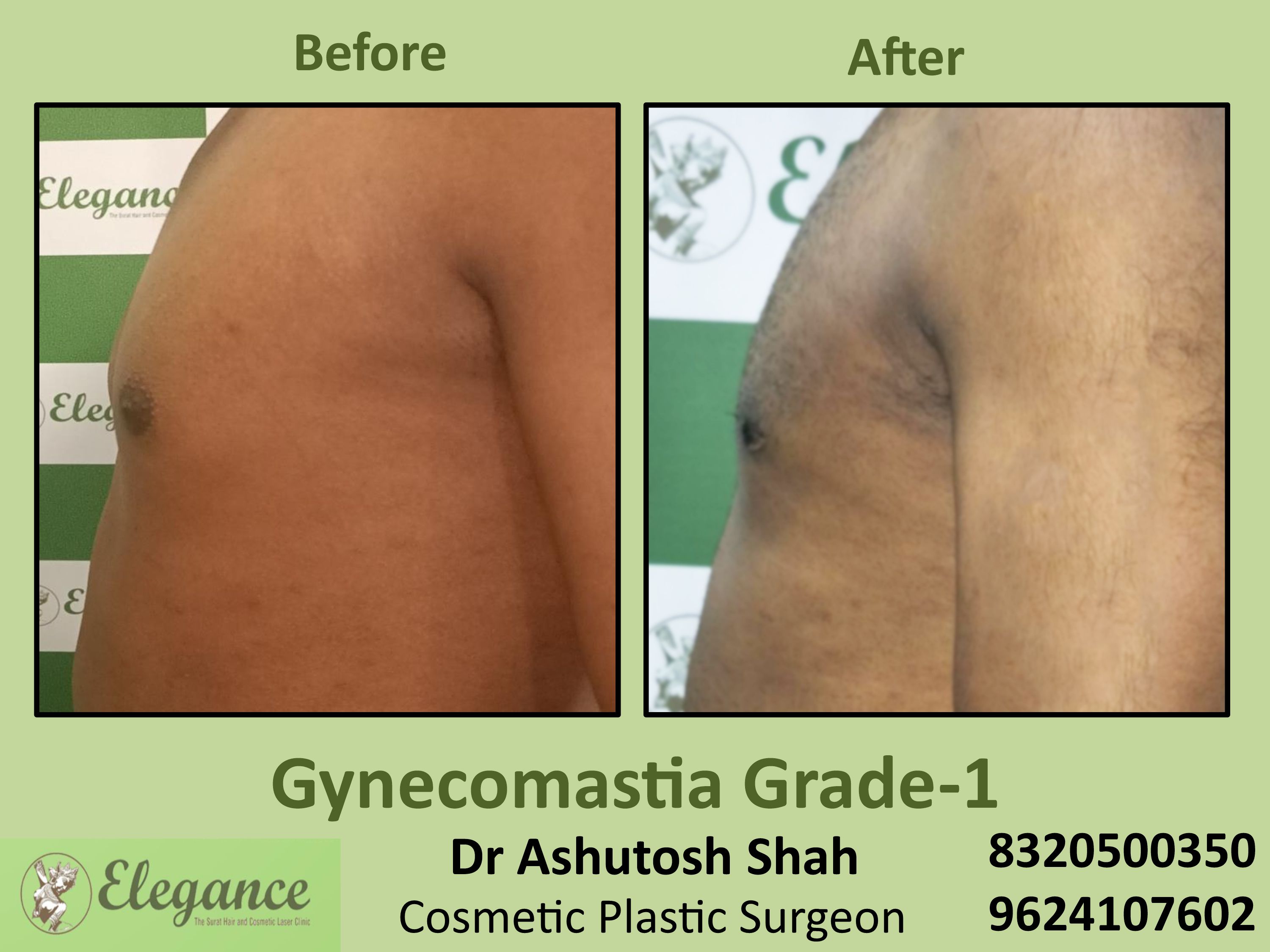 Gynecomastia Grade 1, Best Cosmetic Surgeon in Dumas, Vesu, Surat