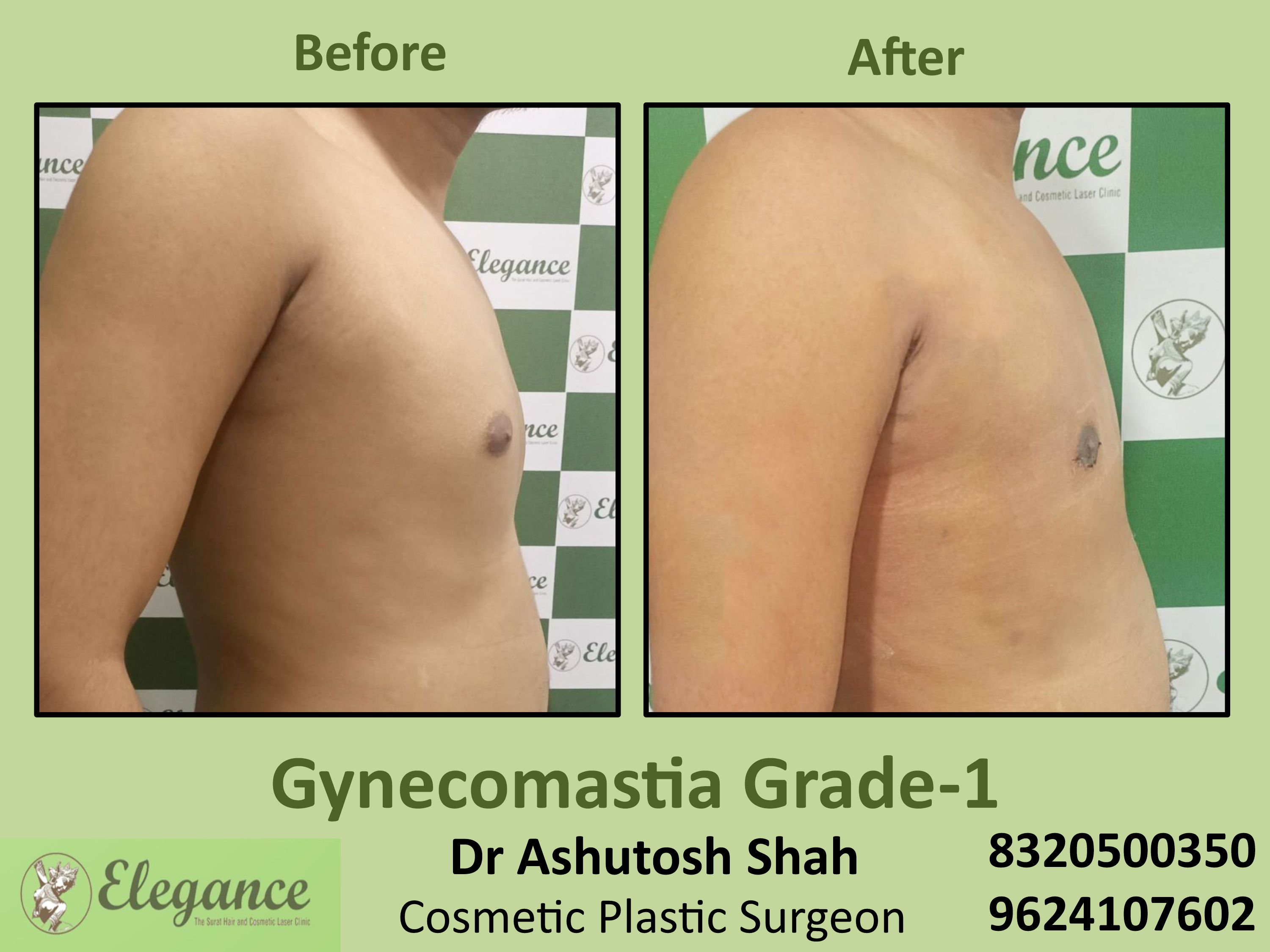 Gynecomastia Grade 1, Best Cosmetic Surgeon in Dumas, Vesu, Piplod, Surat