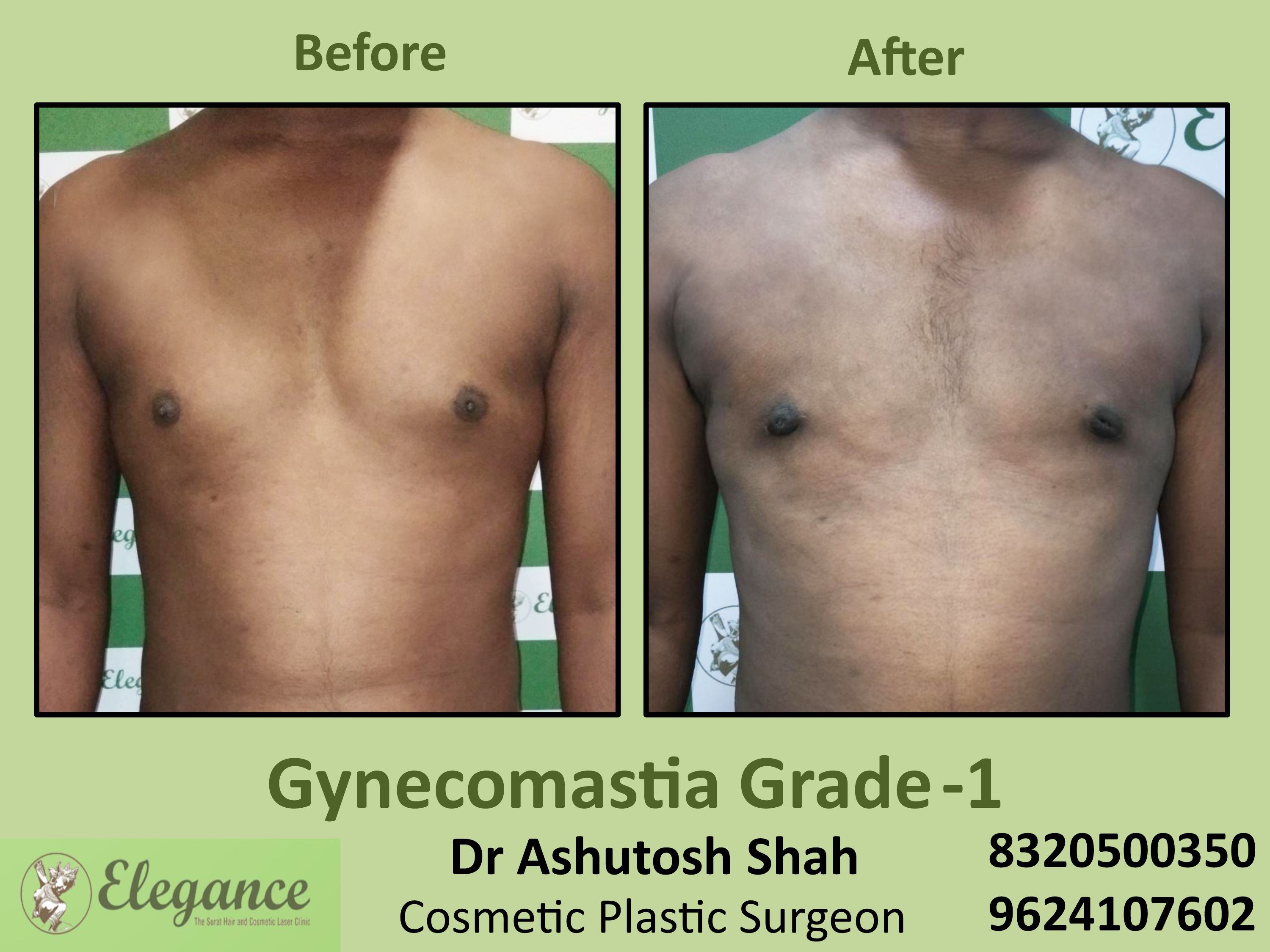Gynecomastia Grade 1, Best Cosmetic Surgeon in Piplod, Surat