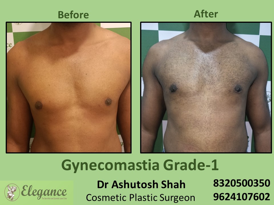 Grade 1 Gynecomastia, Scar Less Keyhole Surgery in Vesu, Surat